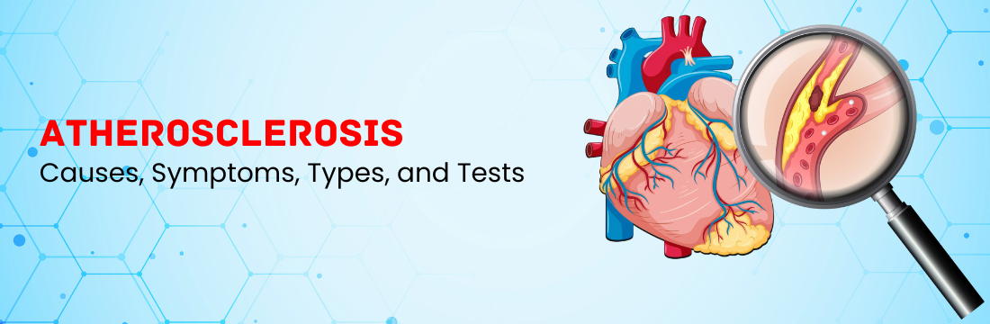 Atherosclerosis Explained: Causes, Symptoms, Types, and Tests